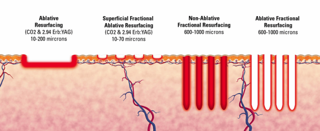 skin laser diagram fractional