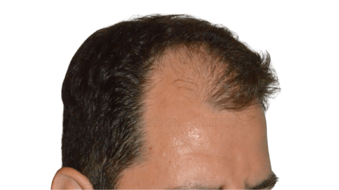 Before-Μεταμόσχευση μαλλιών