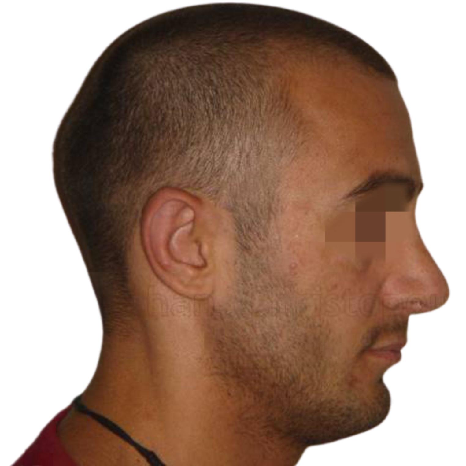 Ρινοπλαστική – Φωτογραφίες Πριν κ Μετά